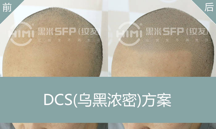 发际线纹发的效果如何？发际线失而复得